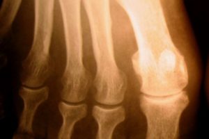 nws_osteoporosi_rischio_frattura_1_uomo_su_5_479_1