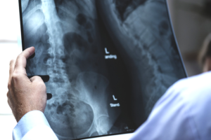 nws_vite_spezzate_l_osteoporosi_colpisce_4_milioni_italiani_1632_1